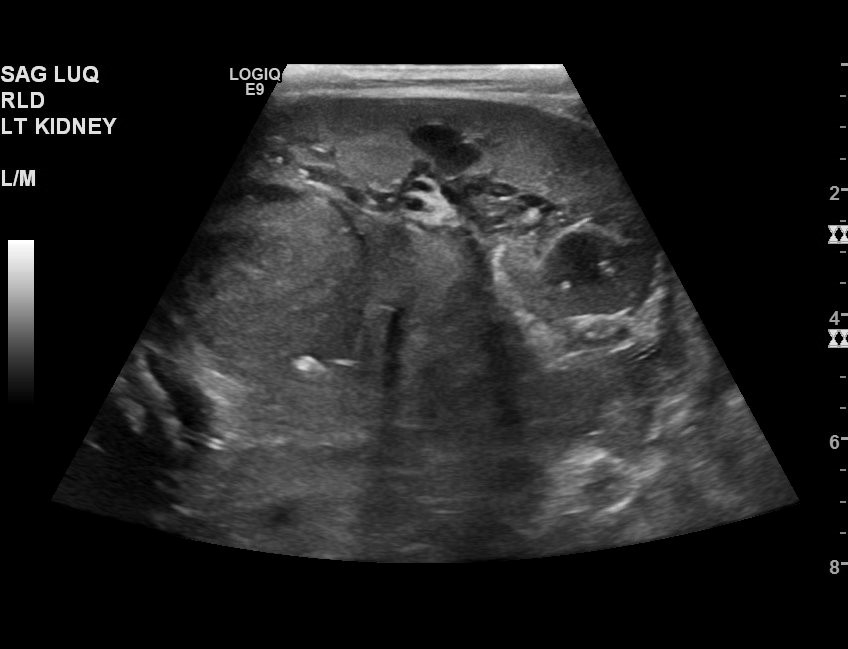 Neuroblastoma (Radiopaedia 47939-52718 Cine Clip 24).jpg