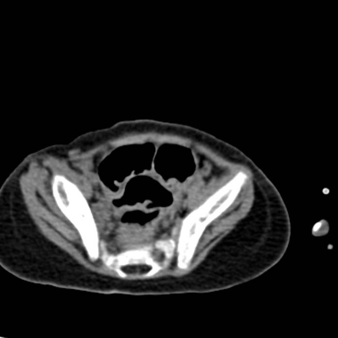Neuroblastoma with skull metastases (Radiopaedia 30326-30960 Axial non-contrast 51).jpg