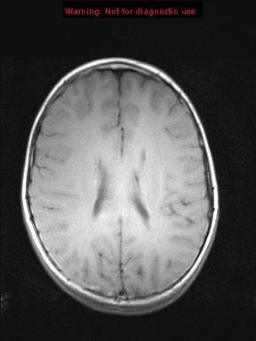 File:Neurofibromatosis type 1 with optic nerve glioma (Radiopaedia 16288-15965 Axial T1 9).jpg