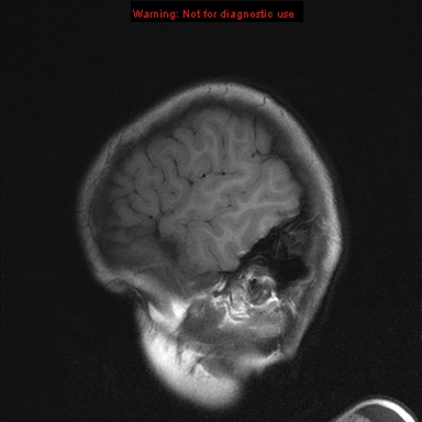 File:Neurofibromatosis type 1 with optic nerve glioma (Radiopaedia 16288-15965 Sagittal T1 3).jpg