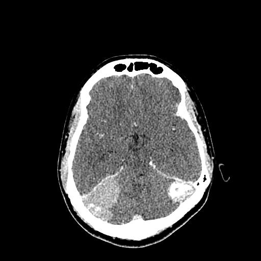 File:Neurofibromatosis type 2 (Radiopaedia 25389-25637 Axial C+ 35).jpg