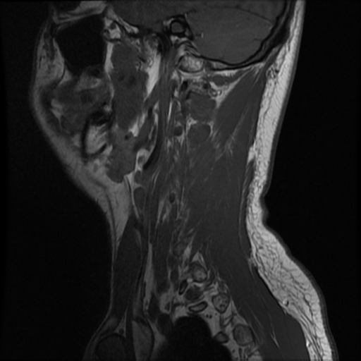 File:Neurofibromatosis type 2 (Radiopaedia 44936-48837 Sagittal T1 1).png