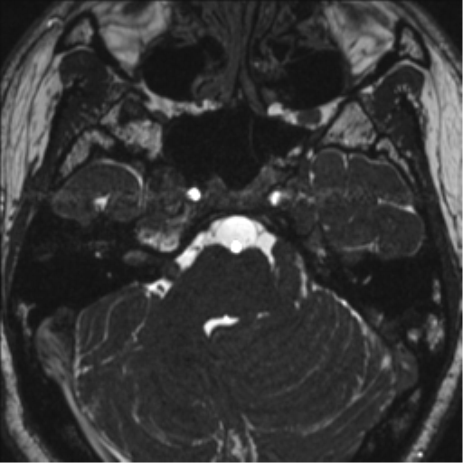 Neurofibromatosis type 2 (Radiopaedia 44936-48838 E 34).png