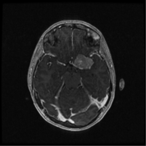 Neurofibromatosis type 2 (Radiopaedia 45229-49244 Axial T1 C+ 52).png