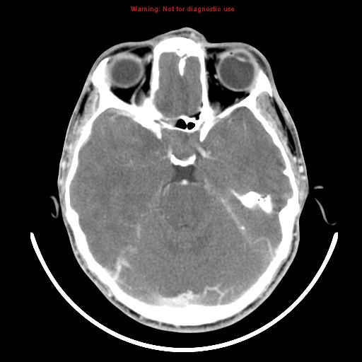 File:Neurofibromatosis type 2 (Radiopaedia 8953-9732 C 11).jpg