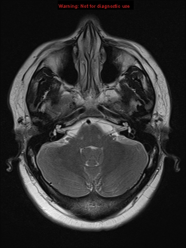 File:Neuroglial cyst (Radiopaedia 10713-11184 Axial T2 18).jpg