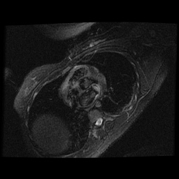 File:Non-compaction of the left ventricle (Radiopaedia 38868-41062 D 15).jpg