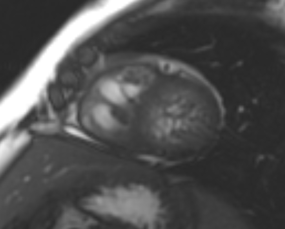File:Non-compaction of the left ventricle (Radiopaedia 69436-79314 Short axis cine 88).jpg
