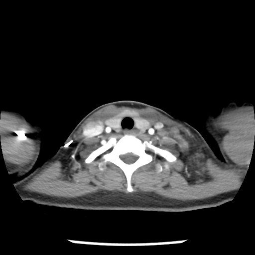 File:Non-small cell lung cancer with miliary metastases (Radiopaedia 23995-24193 A 3).jpg