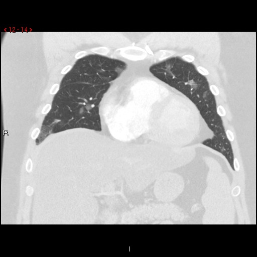 File:Non-specific interstitial pneumonitis (Radiopaedia 27044-27222 Coronal lung window 14).jpg