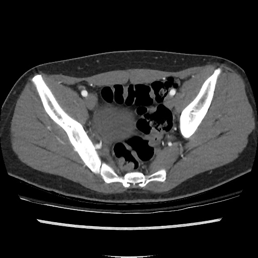 File:Normal CT angiogram of pelvis (Radiopaedia 45390-49430 A 37).jpg