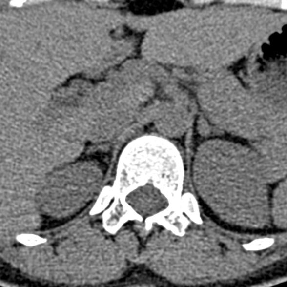 Normal CT lumbar spine (Radiopaedia 53981-60118 Axial non-contrast 4).jpg