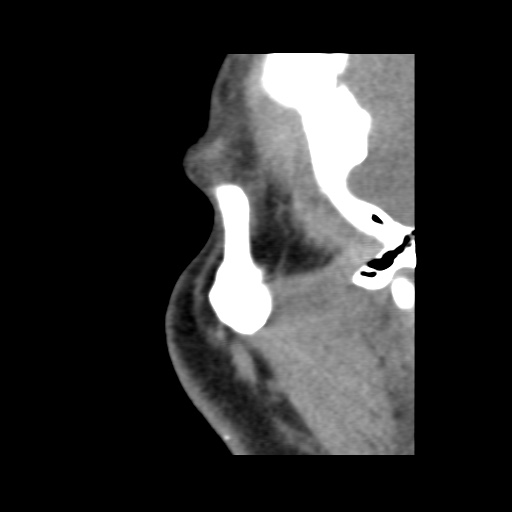 Normal CT paranasal sinuses (Radiopaedia 42286-45390 F 132).jpg