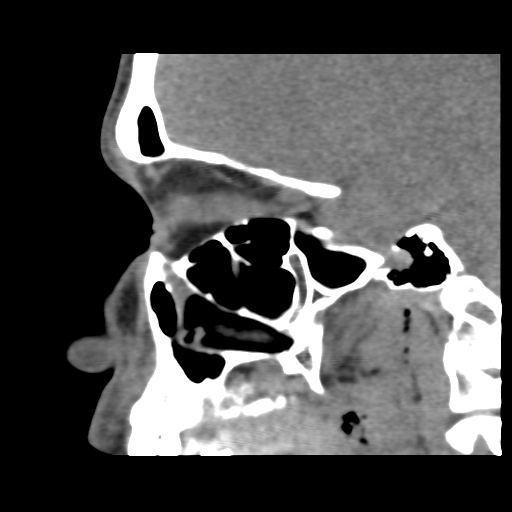 Normal CT paranasal sinuses (Radiopaedia 42286-45390 F 94).jpg