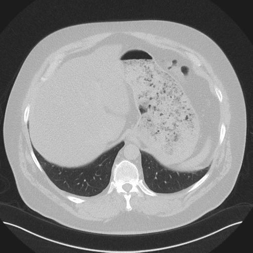 Normal HRCT (Radiopaedia 40797-43458 Axial lung window 51).png