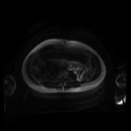 Normal MRI abdomen in pregnancy (Radiopaedia 88001-104541 Axial DWI 110).jpg