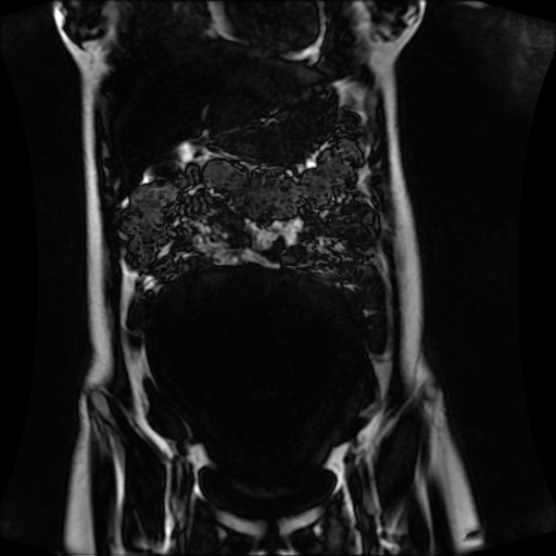Normal MRI abdomen in pregnancy (Radiopaedia 88001-104541 N 48).jpg