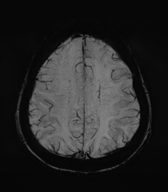 Normal MRI internal auditory canal (Radiopaedia 41613-44525 Axial SWI MIP 58).png