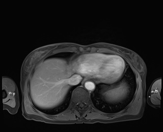 Normal adrenal glands MRI (Radiopaedia 82017-96004 M 10).jpg