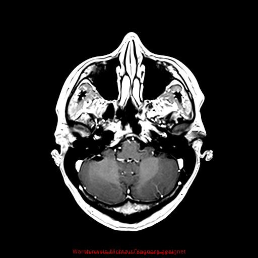 Normal adult brain MRI (non-enhanced and contrast-enhanced) (Radiopaedia 75262-86379 Axial T1 C+ 63).jpg
