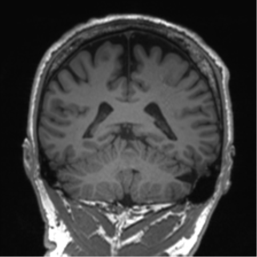 Normal brain MRI (non-focal epilepsy protocol) (Radiopaedia 53917-60040 Coronal T1 25).png