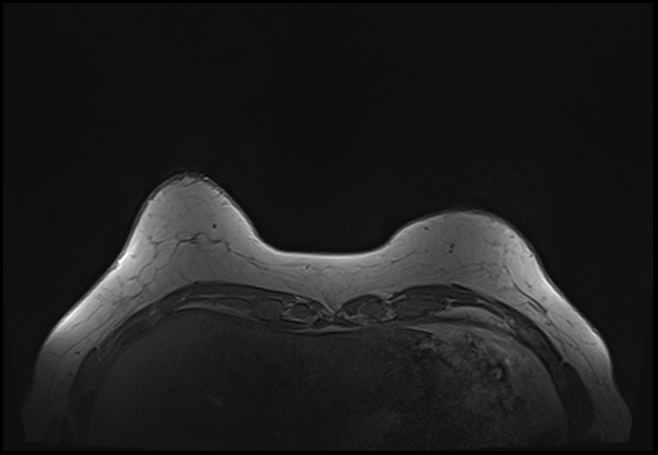 File:Normal breast MRI - dense breasts (Radiopaedia 80454-93850 Axial T1 31).jpg