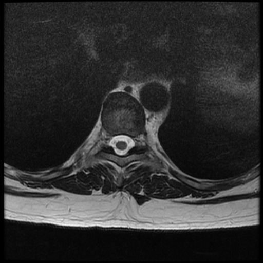 File:Normal cervical and thoracic spine MRI (Radiopaedia 35630-37156 H 18).png