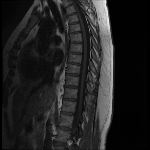 File:Normal cervical and thoracic spine MRI (Radiopaedia 35630-37156 I 8).png