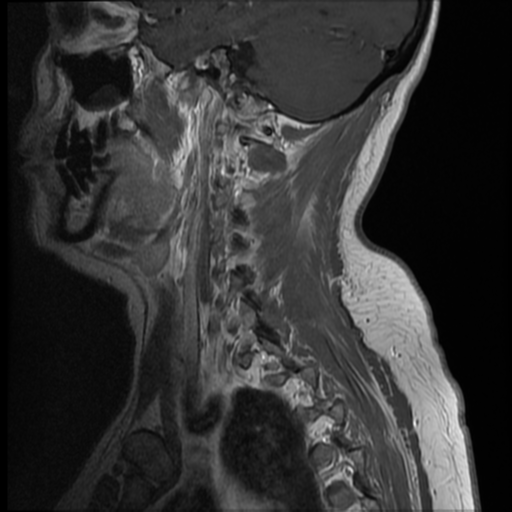 File:Normal cervical and thoracic spine MRI (Radiopaedia 35630-37156 Sagittal T1 C+ 12).png