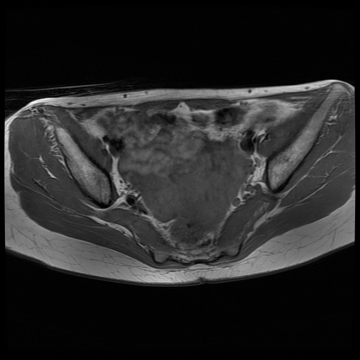 File:Normal female pelvis MRI (retroverted uterus) (Radiopaedia 61832-69933 Axial T1 15).jpg