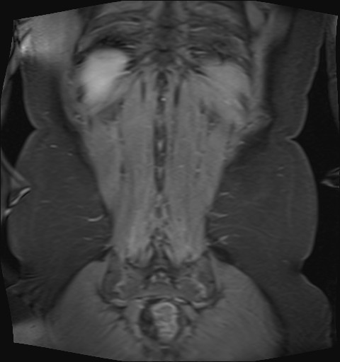 File:Normal hepatobiliary phase liver MRI (Radiopaedia 58968-66230 B 3).jpg