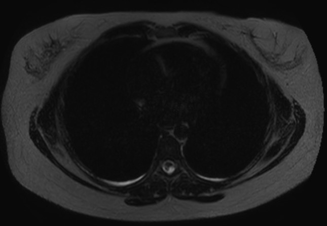 File:Normal liver MRI with Gadolinium (Radiopaedia 58913-66163 E 35).jpg