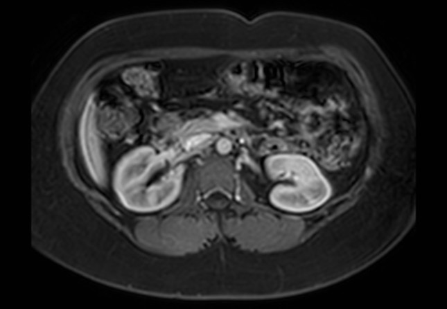 Normal liver MRI with Gadolinium (Radiopaedia 58913-66163 J 22).jpg