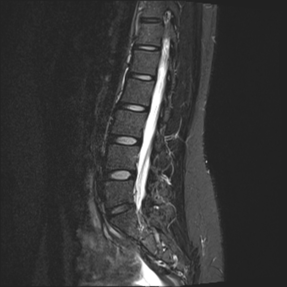 File:Normal lumbar spine MRI- 3 T (Radiopaedia 53280-59250 Sagittal STIR 16).jpg