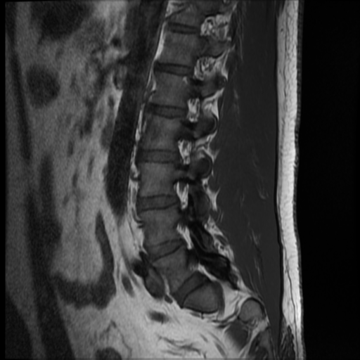 File:Normal lumbar spine MRI (Radiopaedia 35543-37039 Sagittal T1 3).png