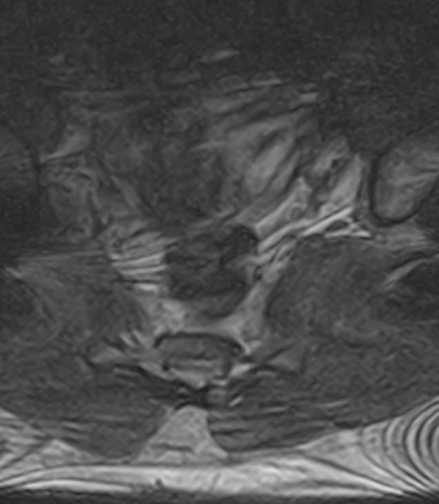 Normal lumbar spine MRI - low-field MRI scanner (Radiopaedia 40976-43699 Axial T2 106).jpg
