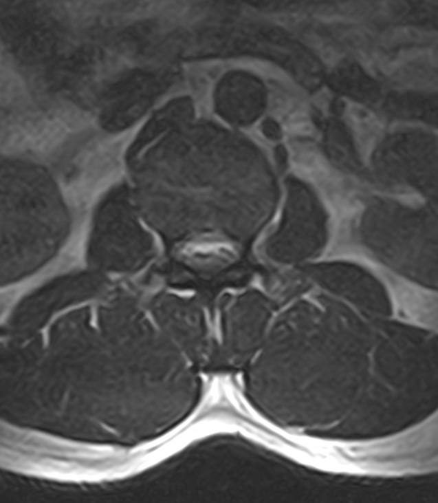 Normal lumbar spine MRI - low-field MRI scanner (Radiopaedia 40976-43699 Axial T2 27).jpg