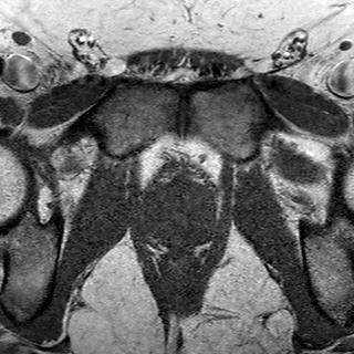 File:Normal prostate (MRI) (Radiopaedia 29986-30535 Axial T1 5).jpg