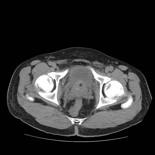 File:Obstructed kidney with perinephric urinoma (Radiopaedia 26889-27067 Axial non-contrast 39).jpg