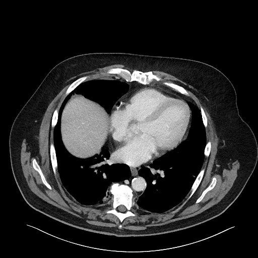 File:Obstructing sigmoid adenocarcinoma (Radiopaedia 58465-65619 A 11).jpg