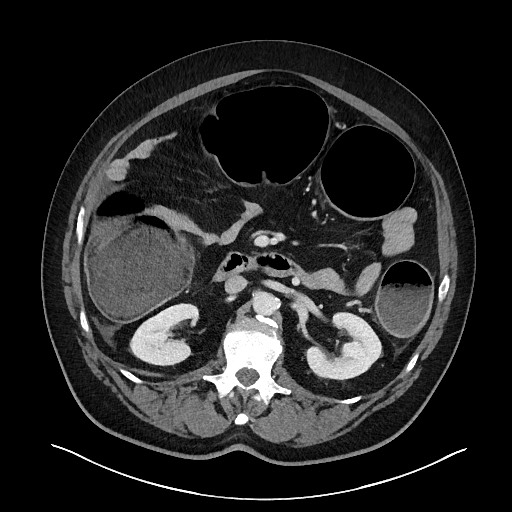 Obstructing sigmoid adenocarcinoma (Radiopaedia 58465-65619 A 67).jpg