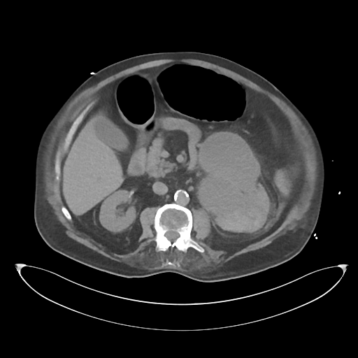 File:Obstructive pyelonephritis (Radiopaedia 46411-50844 Axial non-contrast 34).png