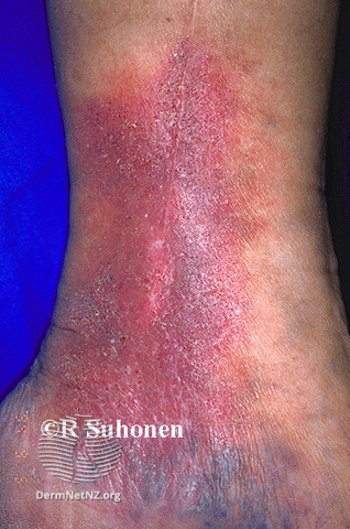 File:(DermNet NZ dermatitis-lichen-simplex-3126).jpg