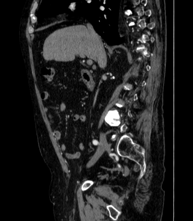 Abdominal aortic aneurysm (Radiopaedia 25855-26001 Sagittal C+ arterial phase 11).jpg