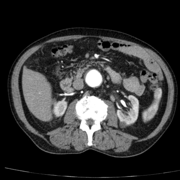 Abdominal aortic aneurysm (Radiopaedia 29248-29660 Axial C+ arterial phase 36).jpg