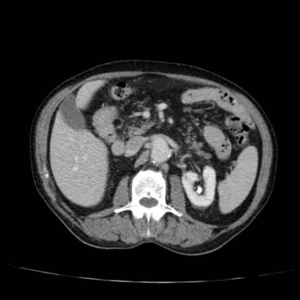 Abdominal aortic aneurysm (Radiopaedia 29248-29660 Axial C+ portal venous phase 24).jpg