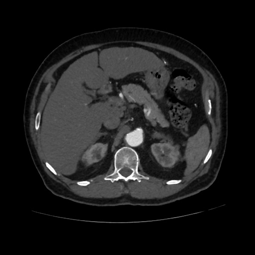 File:Abdominal aortic aneurysm (Radiopaedia 57318-64259 Axial C+ arterial phase 21).jpg