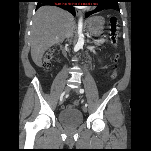 File:Abdominal aortic aneurysm (Radiopaedia 8190-9038 Coronal C+ arterial phase 70).jpg