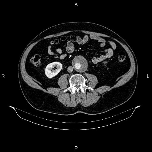 File:Abdominal aortic aneurysm (Radiopaedia 83094-97462 Axial renal cortical phase 110).jpg