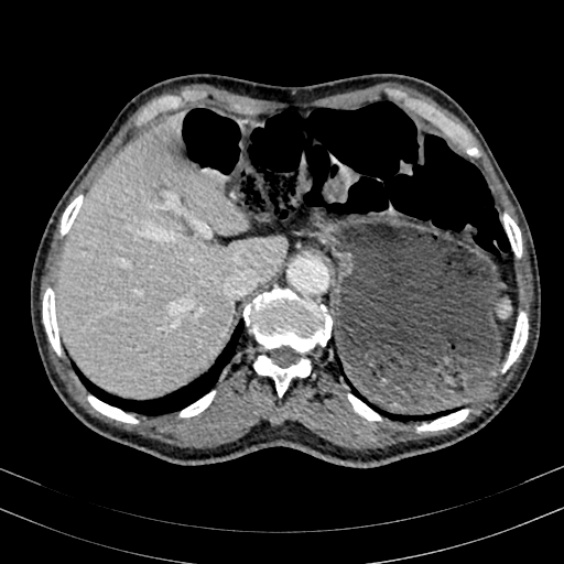 Abdominal aortic aneurysm (Radiopaedia 83581-98689 Axial C+ portal venous phase 22).jpg